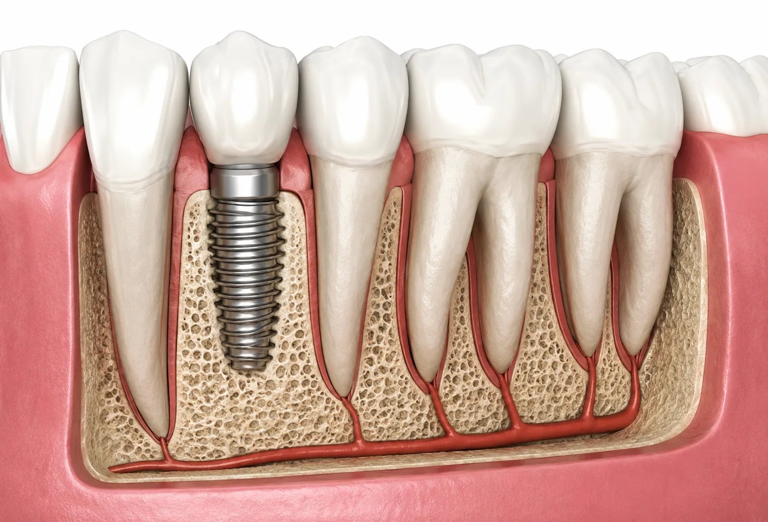Digital guided implants by MDS specialists in Visakhapatnam
